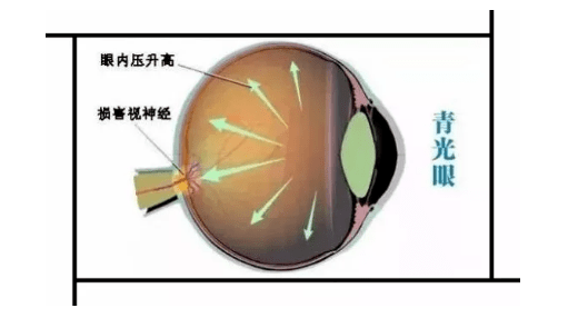 眼睛防护装备，守护视力的关键所在